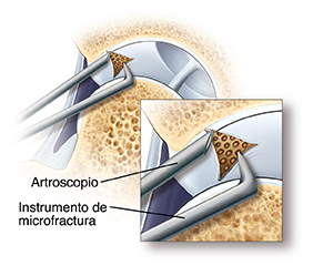 Corte transversal de una articulación de cadera en donde se ve la cabeza del fémur que se separó de la cavidad de la cadera. Parte del cartílago que reviste la cavidad está dañado. La punta del artroscopio está cerca de la zona dañada. Un instrumento de microfacturas está abriendo agujeros pequeños en el hueso por debajo del cartílago dañado.