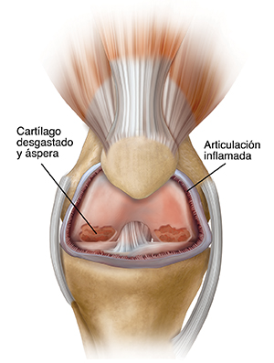 Vista frontal de una rodilla con problemas.