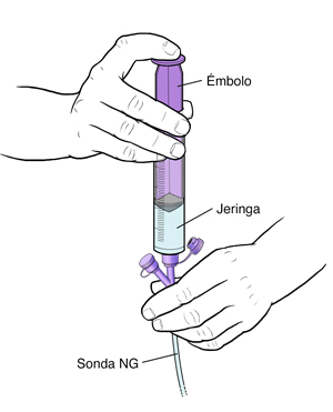 Primer plano de una mano que sostiene una sonda NG con una jeringa insertada en un puerto. La otra mano empuja el émbolo de la jeringa.