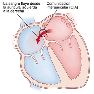 Corte transversal visto de frente de un corazón en donde se ve una comunicación interauricular (CIA) que permite que la sangre pase de la aurícula izquierda a la derecha.